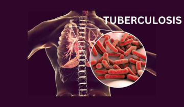 चंडीगढ़ ने 2024 तक शहर को टीबी मुक्त बनाने का लक्ष्य रखा है
