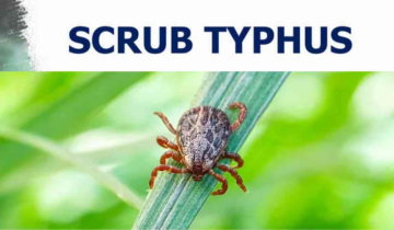 Understanding Scrub Typhus; Odisha's Bargarh District outbreak