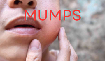 Mumps outbreak hits Kerala, more than 150 cases recorded in 24 hours