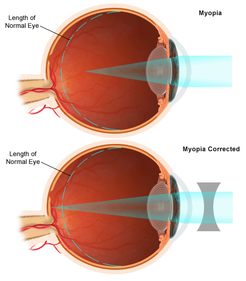 photo: Myopia