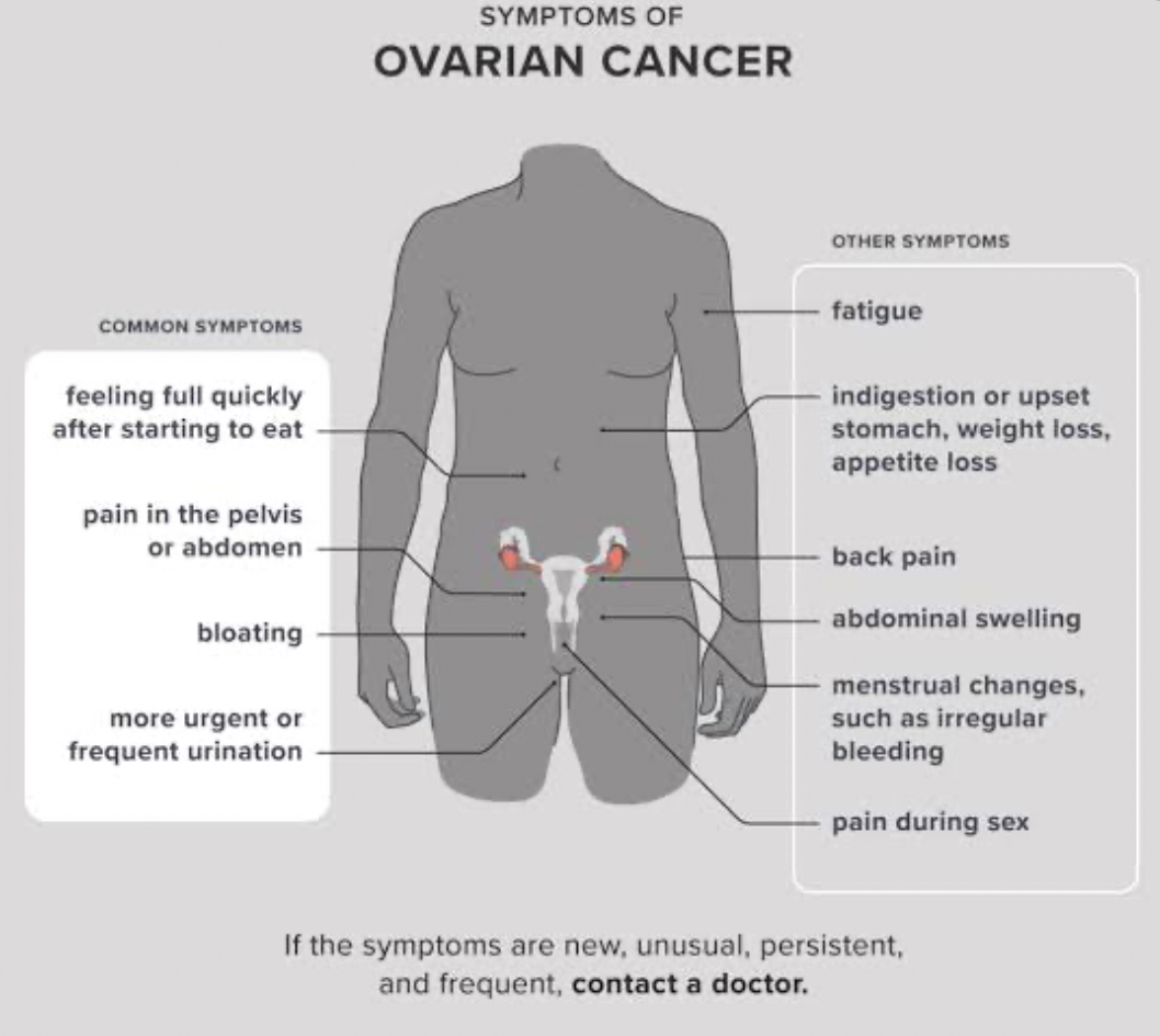 Rising Ovarian Cancer Cases in India Linked to Late Detection