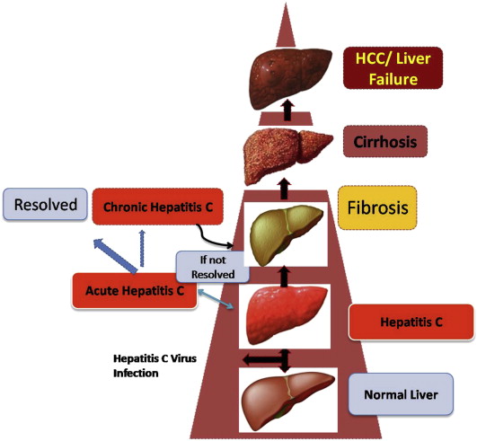 photo: stages of  Liver disease