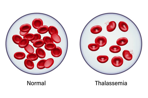 Thalassemia Cells