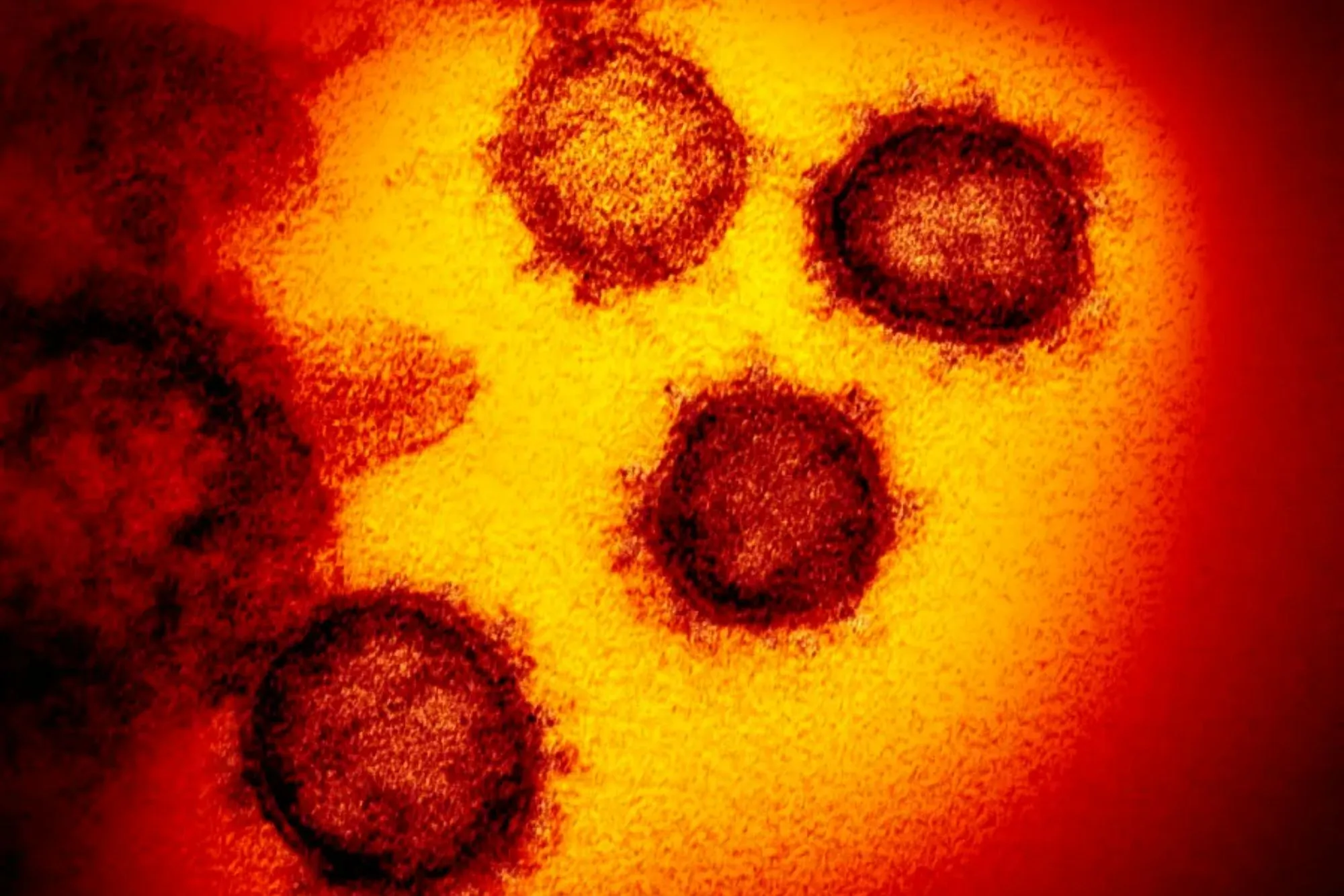 Pic: First human case of new Swine Flu strain detected in UK - What it means