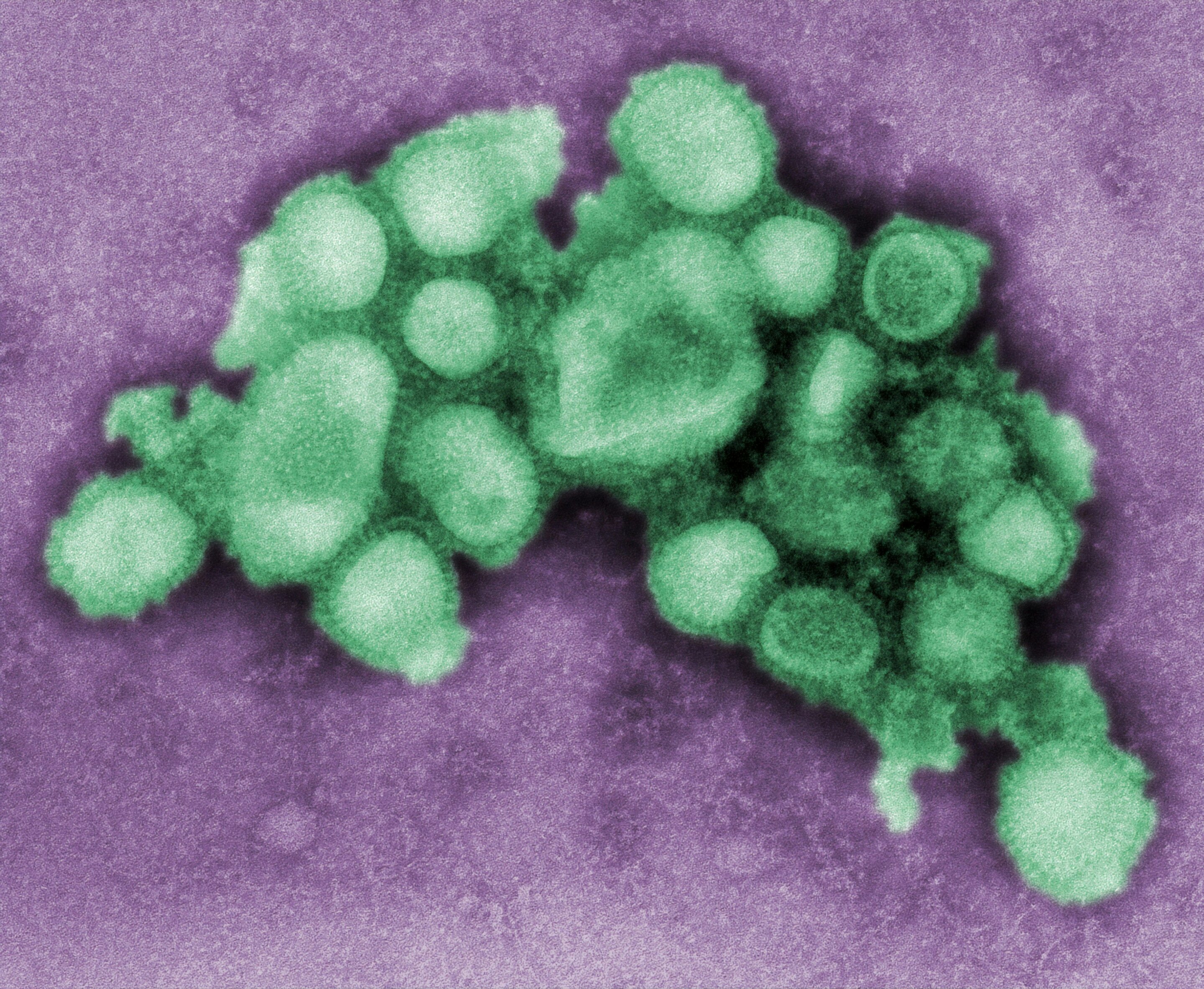 Pic: First human case of new Swine Flu strain detected in UK - What it means